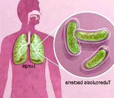 New, simpler optical method to diagnose TB to 