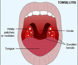 Radiofrequncy-tonsillotomy better treatment option for kids with enlarged tonsils