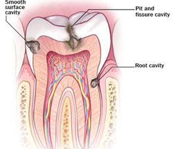 Soon, soundwaves may help find early dental decay