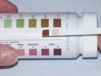 Urine test may help detect cancer