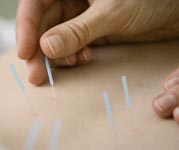 Acupuncture