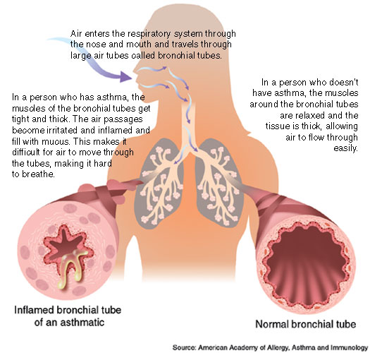 ASTHMA EXPLAINED