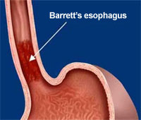 Barrett's Esophagus