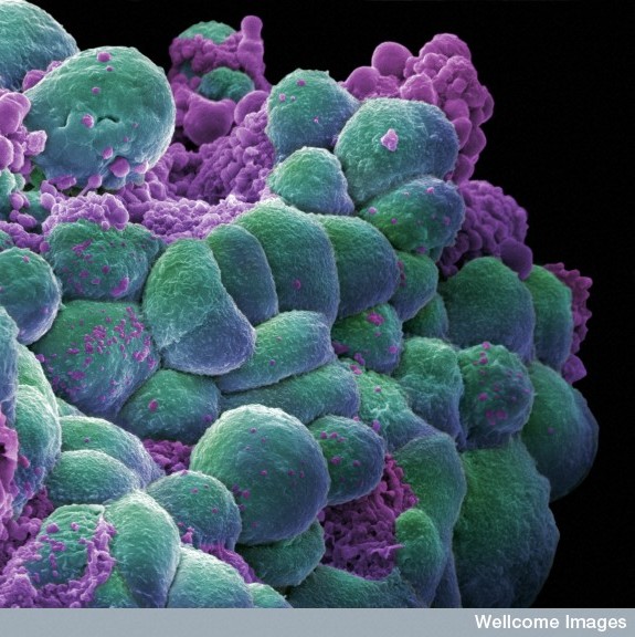 breast cancer cells. The reast cancer cells loop