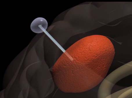 cancer-lures-healthy-cells