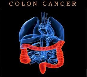 Novel approach to tackle colon cancer