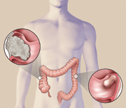 Boffins identify ''cross-talk'' mechanism that contributes to colorectal cancer