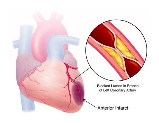 Presence of a variant of the gene indicates the risk of early coronary artery disease