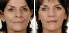 FDA: Dermal Fillers for Wrinkles Linked to Serious Side Effects