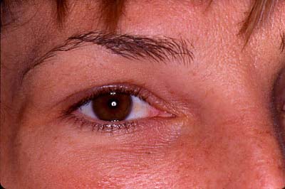 Floppy eyelid syndrome (FES) found to be strongly associated with Obstructive sleep apnea (OSA)