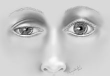 Cosmetic eyelid surgery improves patients’ quality of life