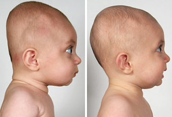 Risk factors in severity of ''flat head syndrome'' in babies identified