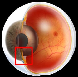 glaucoma