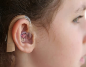 Single sided deafness can be improved by Bone-anchored hearing aids
