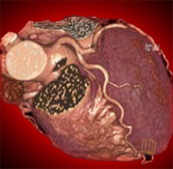  People with lower socio-economic status at higher risk of developing heart disease