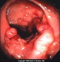 Colon Cancer