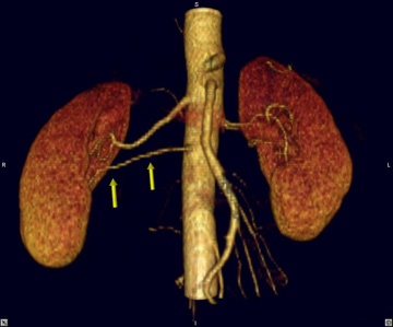 Researchers recommend elimination of routine kidney test for children