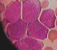 New drug ''can kill leukaemia''
