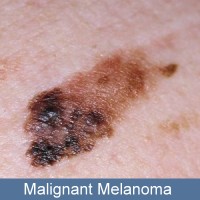 Compounds in green veggies combined with selenium can protect against melanoma