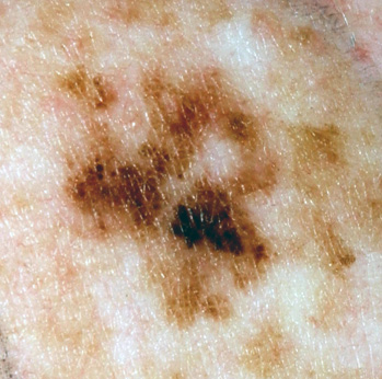 melanoma