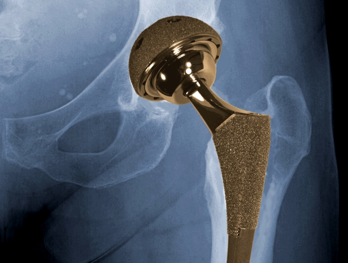 Experts calling for ban on metal-on-metal hip implants