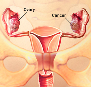 New Research Shows Cancer Cell Migration May Be Stopped