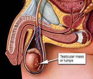 Mental health of testicular cancer patients can be improved by Positive attitude