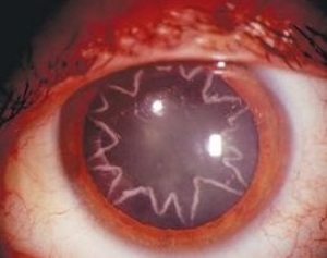 star-shaped-cataracts1004.jpg