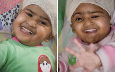 Separated Bangaldeshi twin Trishna wakes up after surgery
