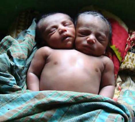 Baby Kiron dies after struggle for life in Bangladesh 