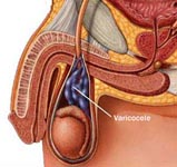 Varicocele