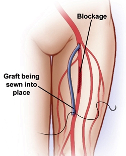 vascular disease risk