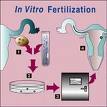 Assisted Reproductive Technology (ART) Linked to Birth Defects
