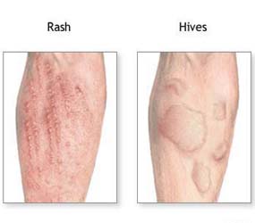 Garden plants which suits allergic people