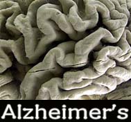 Alzheimer''s