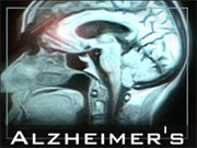 Family history raises Alzheimer’s risk