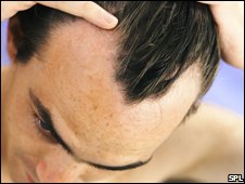 New Genetic Links To Male Pattern Baldness Discovered