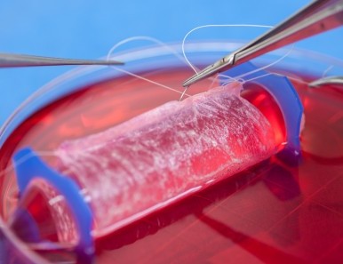 Bio-engineered vaginas developed using the patients’ own cells