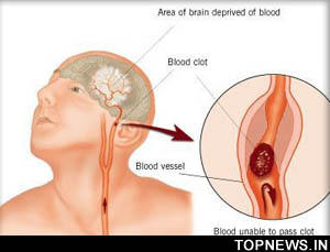 Rigorous visual training can make partially blind stroke patients see again