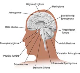 Researchers Create New Technique Shaking Brain Cancer Cells To Death