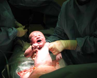 Women should not treat Caesarean lightly, gynaecologists say
