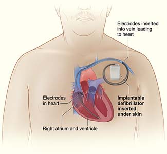 Genetic Variation Protects From Sudden Cardiac Arrest