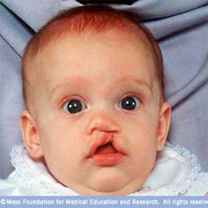 Misery of cleft palates may end with the help of a gel