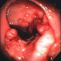 High Risk Of Colon Cancer In Overweight Men