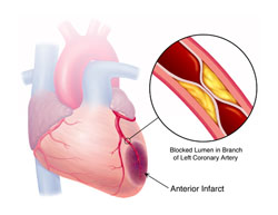 Transcendental Mediation Reduces Risk of Death from Coronary Heart Disease - Research 