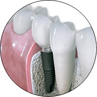 Dental Implants Cut Down The Cost By Over 60%