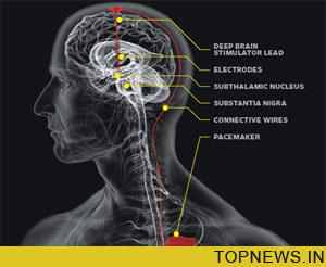 Gene that switches on during epilepsy development identified