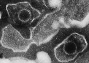 Epstein-Barr virus seems to play role in multiple sclerosis progression