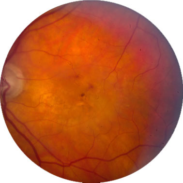 Genes associated with age-related macular degeneration identified