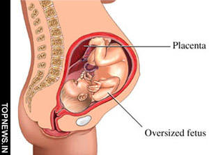 Gestational diabetes during pregnancy doubles language delay risk in kids